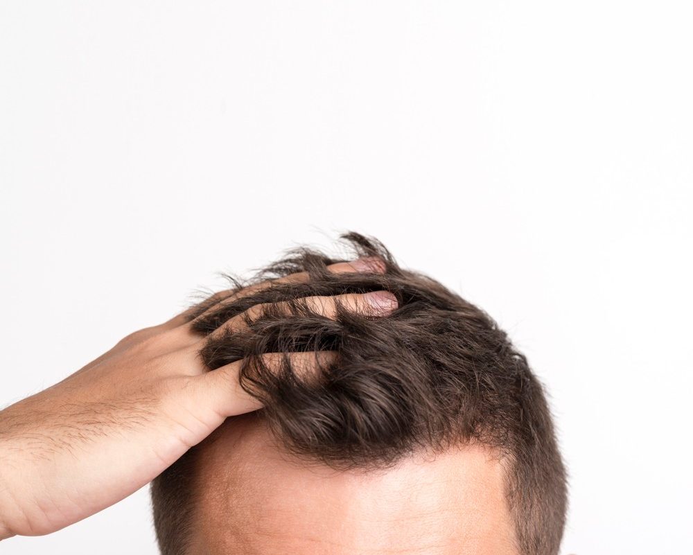 man-having-hair-fall-problem-standing-against-white-background